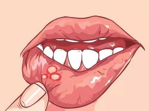 口腔溃疡能抽电子烟吗？